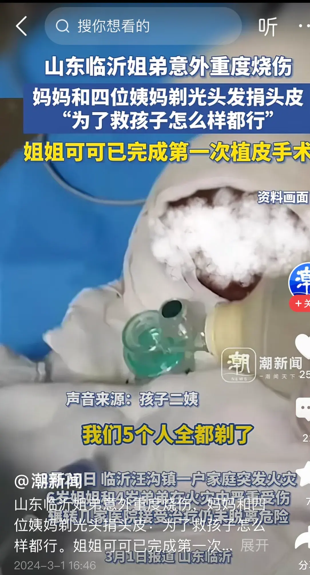 姐弟燒傷四位姨媽剃光頭捐頭皮