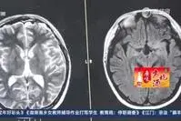 男孩一天喝9升水被查出腫瘤
